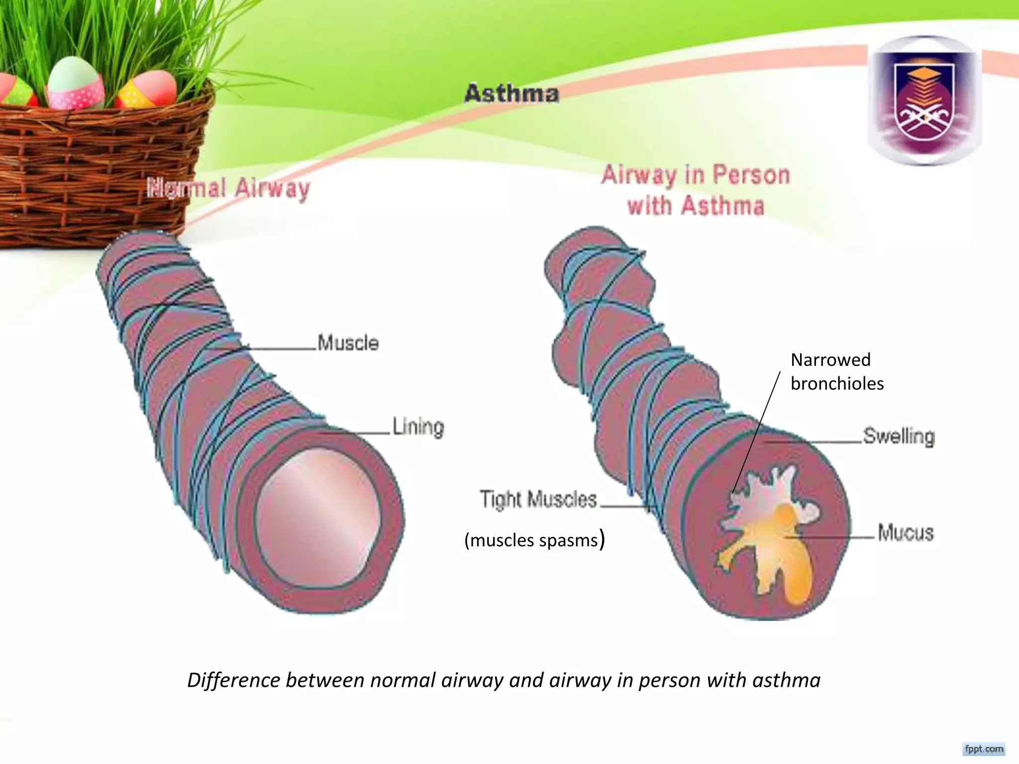 Difference between normal airway and airway in person with asthma
Narrowed
bronchioles
(muscles spasms)
 
