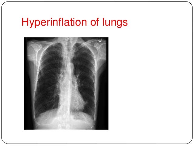 Asthma Case Presentation