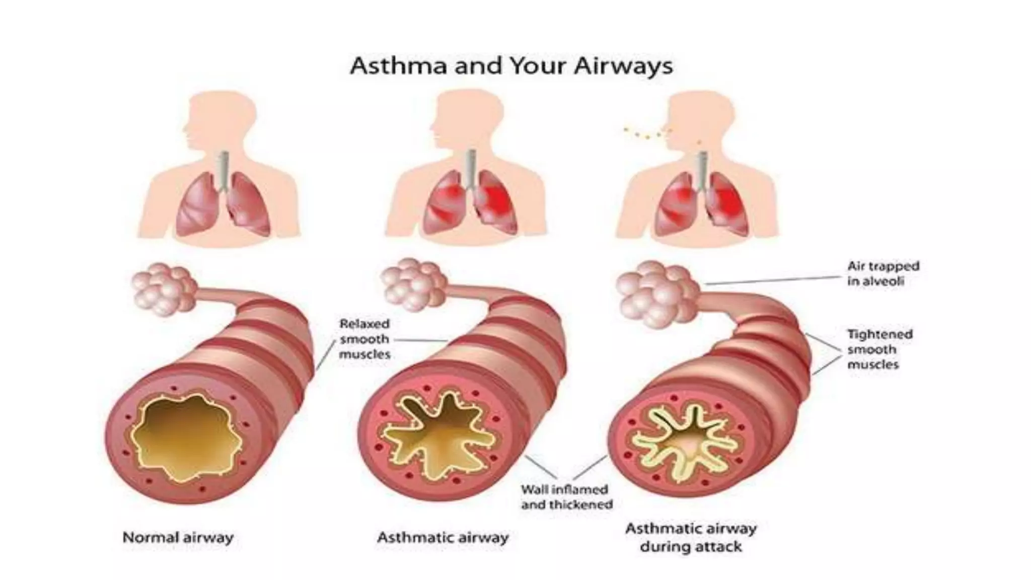 pathophysiology of asthma and COPD | PPTX