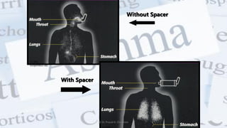©1998,
Respironics Inc.
Without Spacer
With Spacer
@ Dr. Prasad B. Chinchole
 