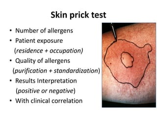 Skin prick test
• Number of allergens
• Patient exposure
(residence + occupation)
• Quality of allergens
(purification + standardization)
• Results Interpretation
(positive or negative)
• With clinical correlation
 