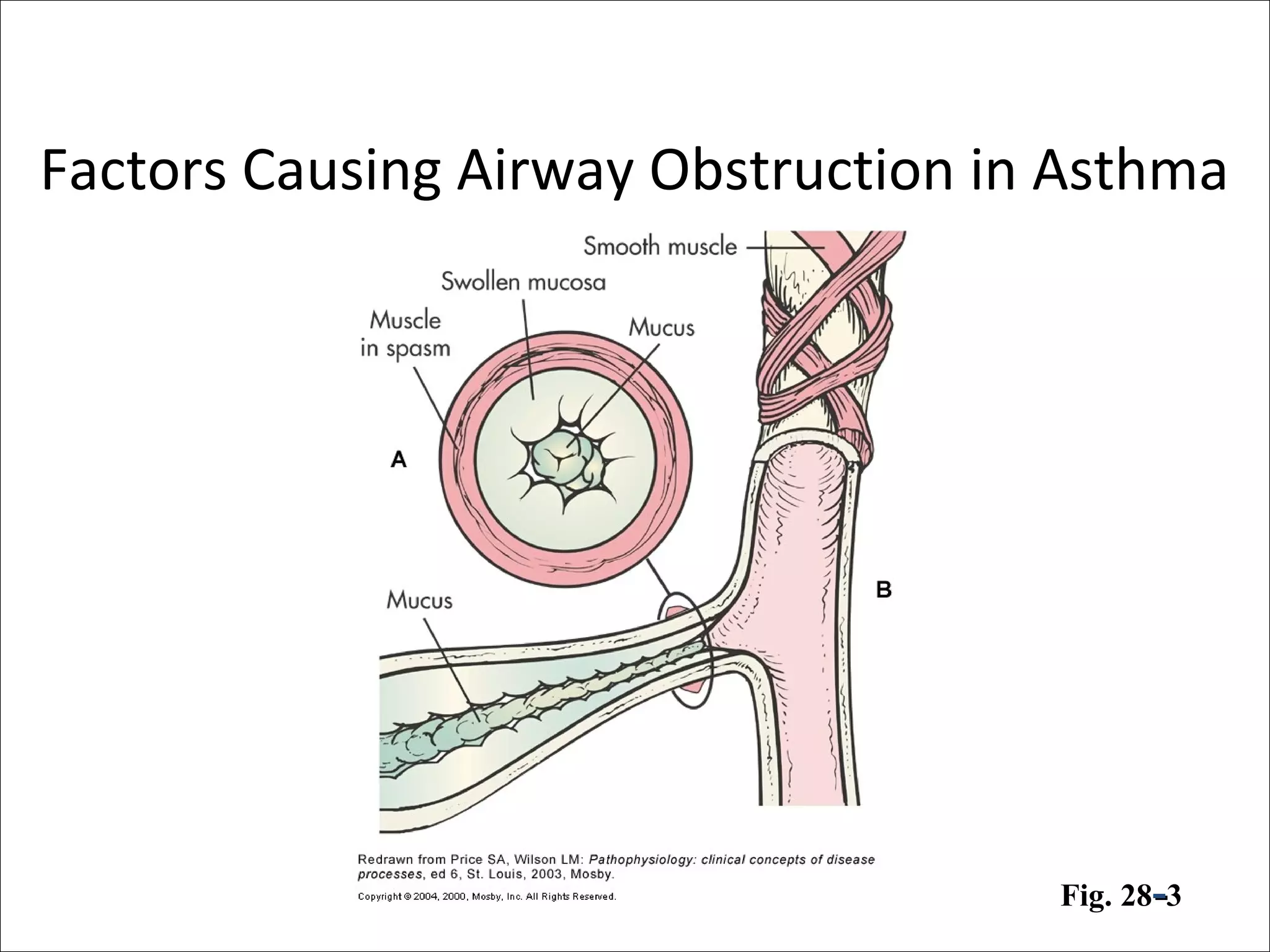 Factors Causing Airway Obstruction in Asthma
Fig. 28--3
 