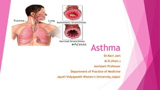 Asthma
Dr.Ravi Jain
M.D.(Hom.)
Assistant Professor
Department of Practice of Medicine
Jayoti Vidyapeeth Women’s University,Jaipur
 