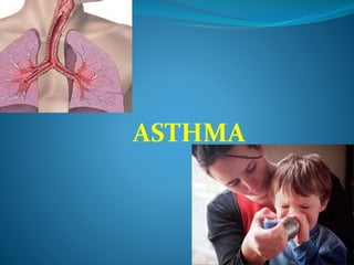 ASTHMA
 
