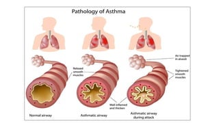 Bronchial asthma is characterised by dyspnoea and wheeze due to
increased resistance to the flow of air through the bronch...