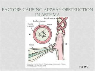 FACTORS CAUSING AIRWAY OBSTRUCTION
IN ASTHMA
Fig. 28-3
 