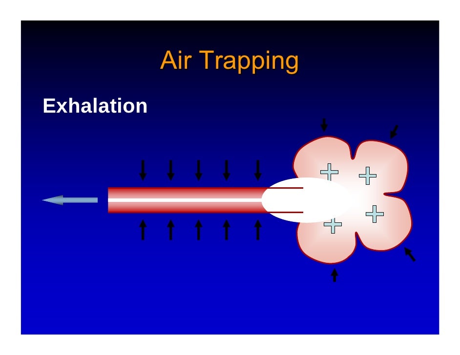 asthma trapping airway hyperinflation therapies directed