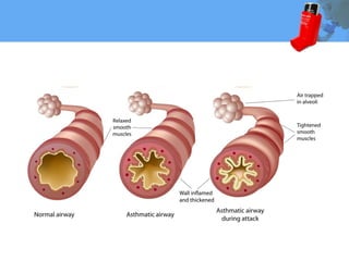 Powerpoint Design With Rota Inhaler Asthma-inhaler-PowerPoint-Templates-Standard (1).pptx