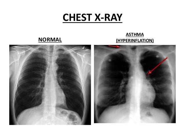asthma-overview