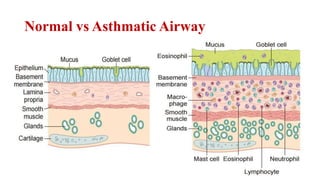 Normal vs Asthmatic Airway
 
