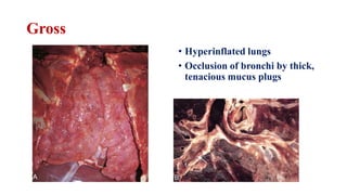 Gross
• Hyperinflated lungs
• Occlusion of bronchi by thick,
tenacious mucus plugs
 