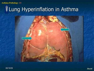 Lung Hyperinflation in Asthma 06/16/09 