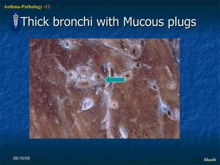 Thick bronchi with Mucous plugs 06/16/09 
