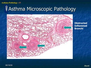 Asthma Microscopic Pathology 06/16/09 Obstructed Inflammed Bronchi 