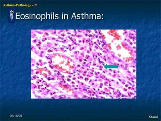 Eosinophils in Asthma: 06/16/09 