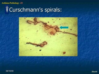 Curschmann's spirals: 06/16/09 