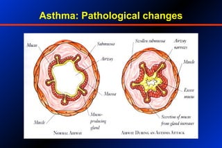 Asthma: Pathological changes
 