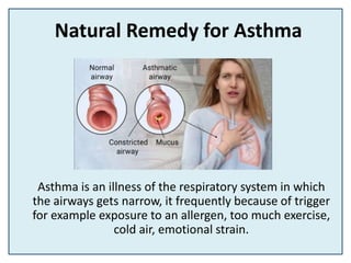 Natural Remedy for Asthma
Asthma is an illness of the respiratory system in which
the airways gets narrow, it frequently because of trigger
for example exposure to an allergen, too much exercise,
cold air, emotional strain.
 