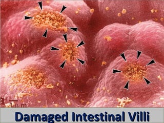 Damaged Intestinal Villi
 