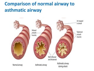 Comparison of normal airway to
asthmatic airway
 