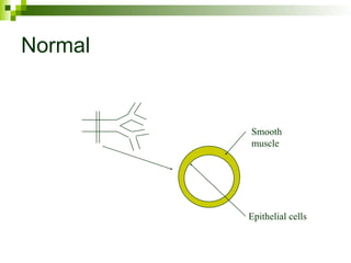 Normal
Smooth
muscle
Epithelial cells
 