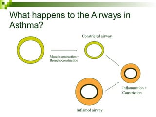 What happens to the Airways in
Asthma?
Muscle contraction =
Bronchoconstriction
Constricted airway
Inflamed airway
Inflammation +
Constriction
 