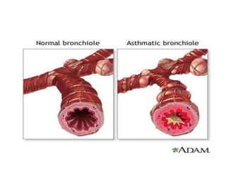 Type of asthma
 