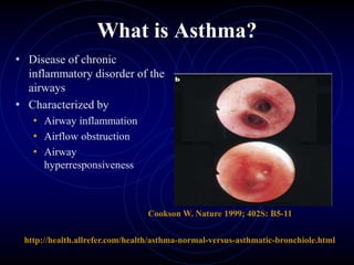What is Asthma?
• Disease of chronic
inflammatory disorder of the
airways
• Characterized by
• Airway inflammation
• Airflow obstruction
• Airway
hyperresponsiveness
http://health.allrefer.com/health/asthma-normal-versus-asthmatic-bronchiole.html
Cookson W. Nature 1999; 402S: B5-11
 
