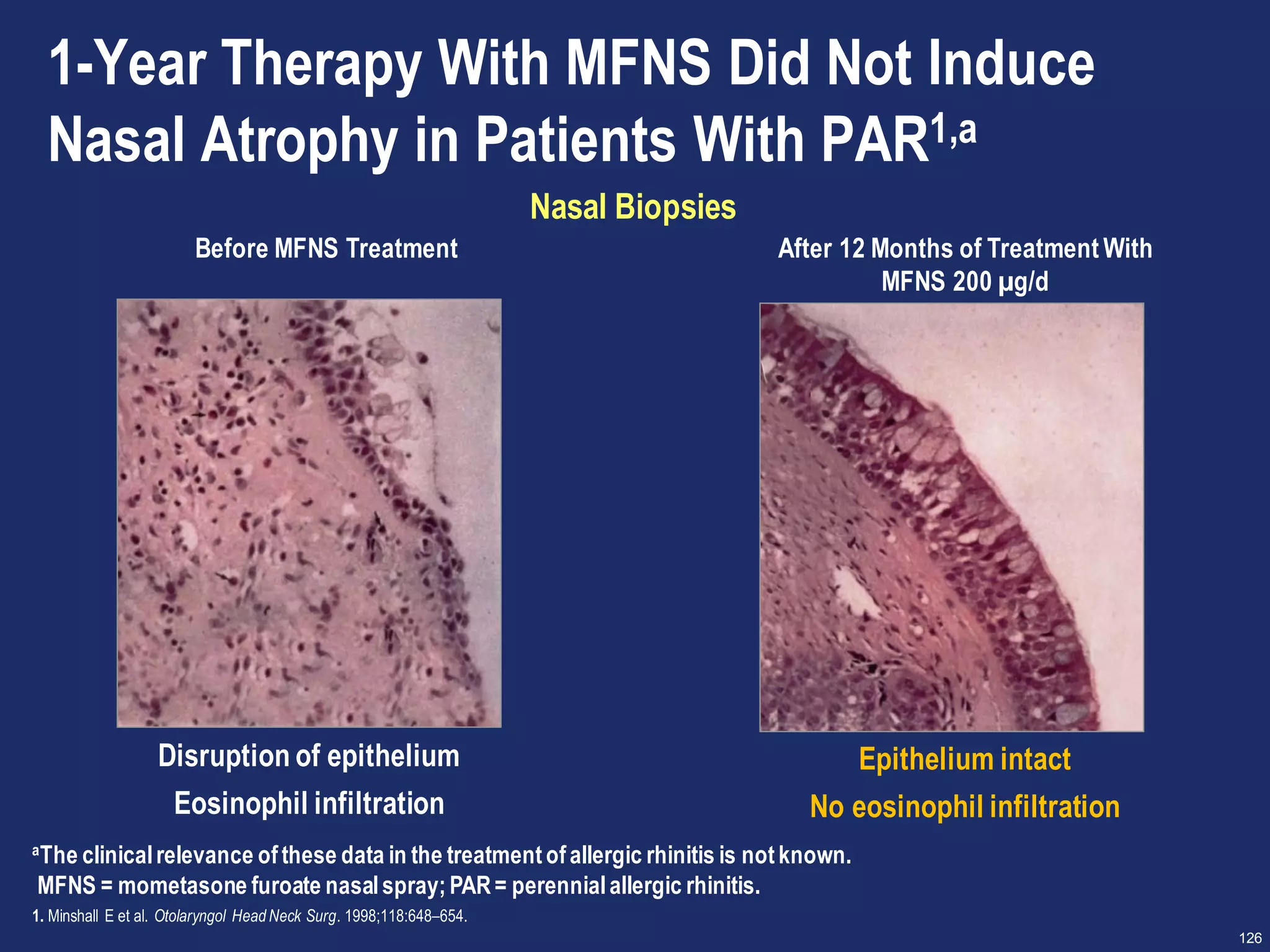 126
1-Year Therapy With MFNS Did Not Induce
Nasal Atrophy in Patients With PAR1,a
Nasal Biopsies
Before MFNS Treatment After 12 Months of Treatment With
MFNS 200 µg/d
Disruption of epithelium
Eosinophil infiltration
Epithelium intact
No eosinophil infiltration
aThe clinicalrelevance ofthese data in the treatmentofallergic rhinitis is notknown.
MFNS = mometasone furoate nasalspray;PAR= perennialallergic rhinitis.
1. Minshall E et al. Otolaryngol Head Neck Surg. 1998;118:648–654.
 