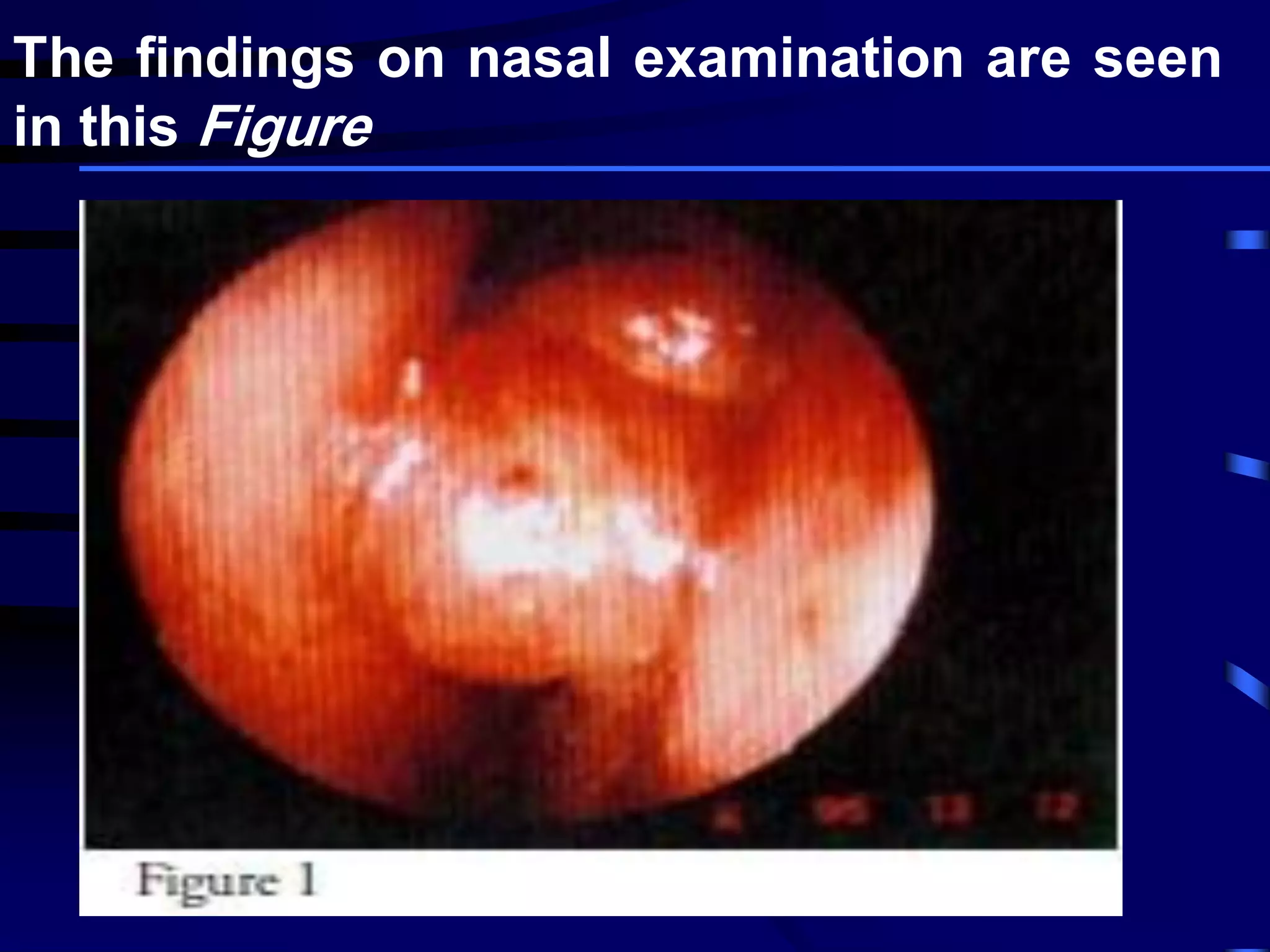 The findings on nasal examination are seen
in this Figure
 