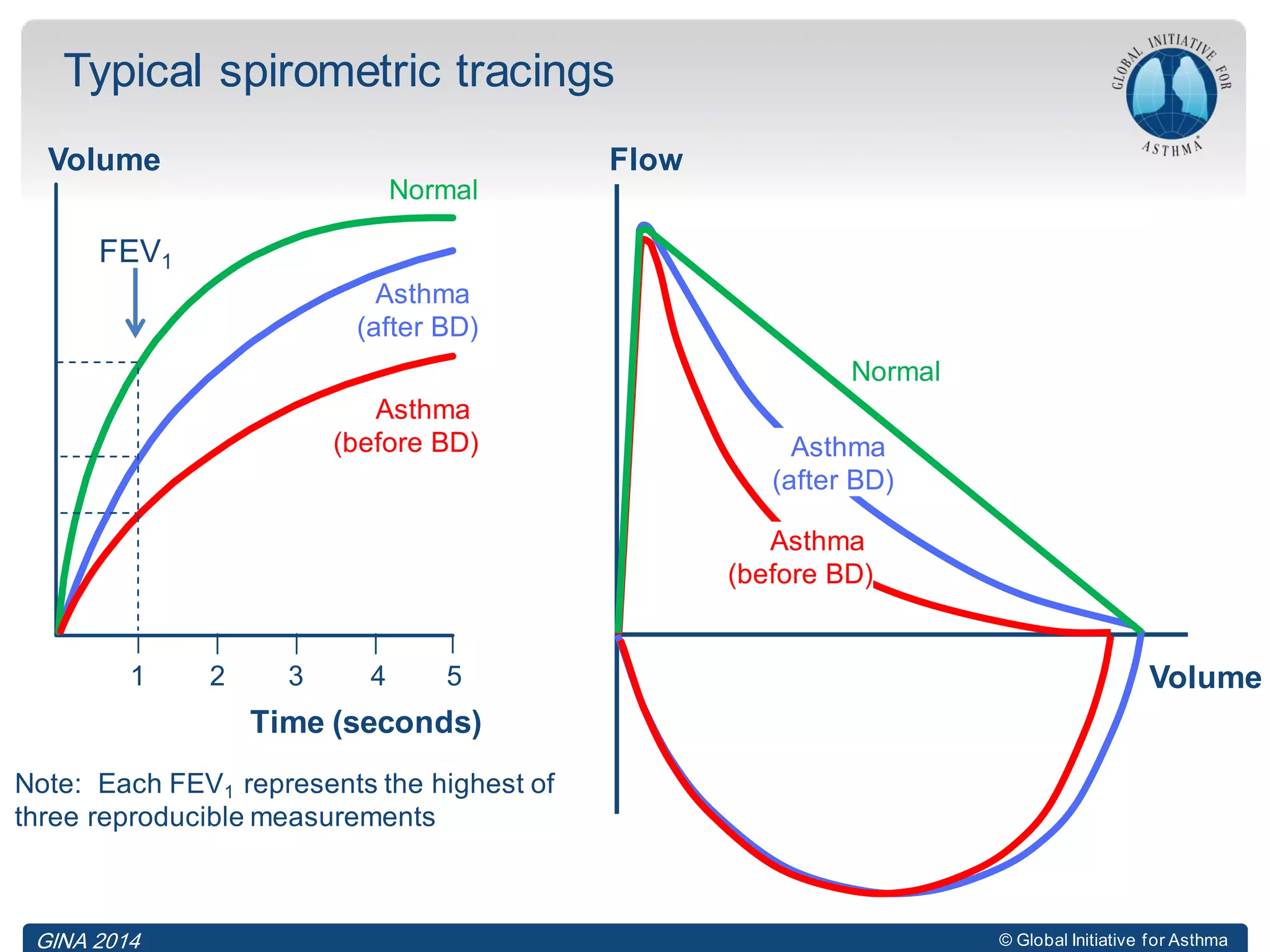 © Global Initiative for Asthma
Time (seconds)
Volume
Note: Each FEV1 represents the highest of
three reproducible measurements
Typical spirometric tracings
FEV1
1 2 3 4 5
Normal
Asthma
(after BD)
Asthma
(before BD)
Flow
Volume
Normal
Asthma
(after BD)
Asthma
(before BD)
GINA 2014
 