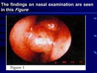 The findings on nasal examination are seen
in this Figure
 