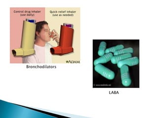 Asthma | PPTX