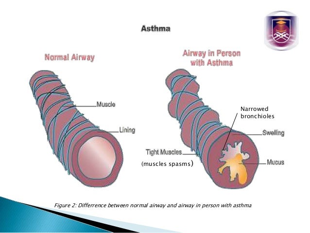 Asthma Anatomy And Physiology - Asthma Lung Disease