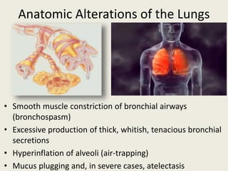 Anatomic Alterations of the Lungs
• Smooth muscle constriction of bronchial airways
(bronchospasm)
• Excessive production of thick, whitish, tenacious bronchial
secretions
• Hyperinflation of alveoli (air-trapping)
• Mucus plugging and, in severe cases, atelectasis
 