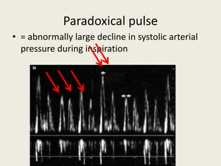 Paradoxical pulse
• = abnormally large decline in systolic arterial
pressure during inspiration
 