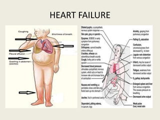 HEART FAILURE
 