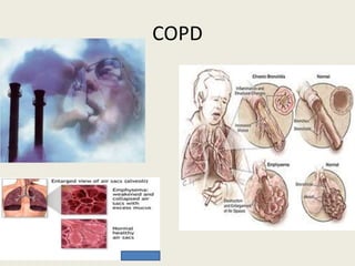 COPD
 