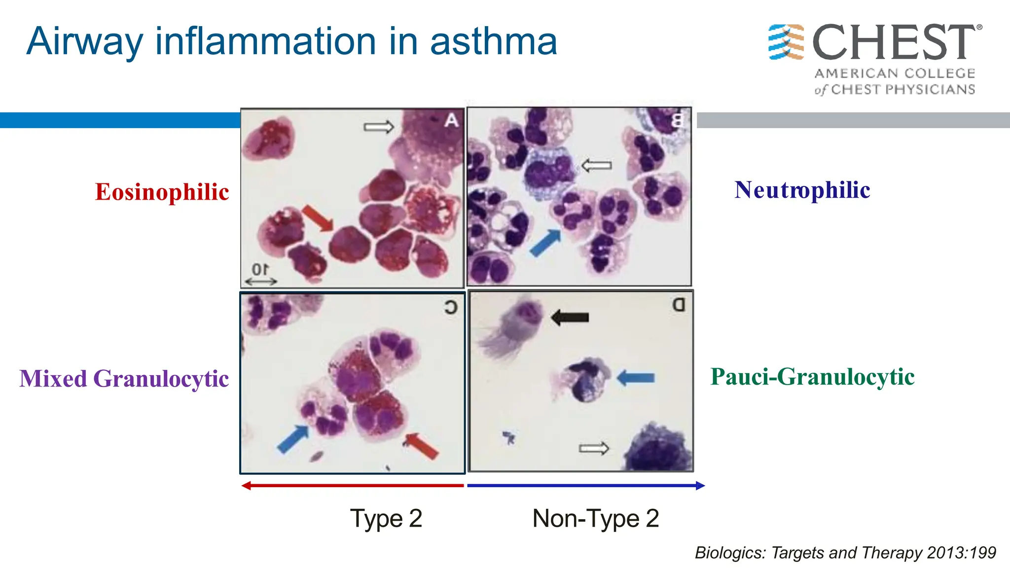 Biologics: Targets and Therapy 2013:199
Airway inflammation in asthma
Neutrophilic
Mixed Granulocytic Pauci-Granulocytic
Eosinophilic
Non-Type 2
Type 2
 