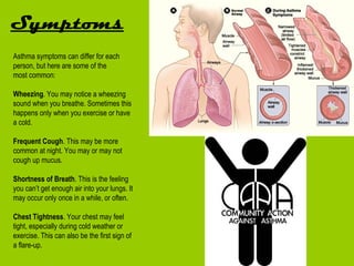 Symptoms
Asthma symptoms can differ for each
person, but here are some of the
most common:

Wheezing. You may notice a wheezing
sound when you breathe. Sometimes this
happens only when you exercise or have
a cold.

Frequent Cough. This may be more
common at night. You may or may not
cough up mucus.

Shortness of Breath. This is the feeling
you can’t get enough air into your lungs. It
may occur only once in a while, or often.

Chest Tightness. Your chest may feel
tight, especially during cold weather or
exercise. This can also be the first sign of
a flare-up.
 
