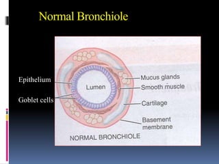 Normal Bronchiole
Epithelium
Goblet cells
 