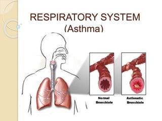 RESPIRATORY SYSTEM
(Asthma)
 