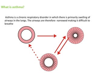Asthma is a chronic respiratory disorder in which there is primarily swelling of
airways in the lungs. The airways are therefore narrowed making it difficult to
breathe          Normal                              Inflamed (untreated)




              Regular
              Inhaled
              Steroid                               Partly
                                                    Treated
 
