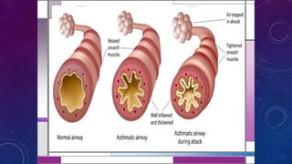 Asthma in the Emergency Room Presentation.pptx