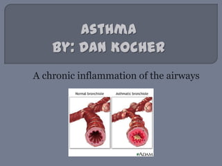 AsthmaBy: Dan Kocher A chronic inflammation of the airways 