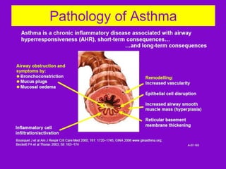 Pathology of Asthma

 