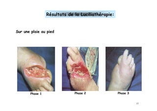 Résultats de la Luciliathérapie:


Sur une plaie au pied




        Phase 1                Phase 2               Phase 3


                                                               15
 
