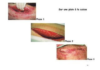 Sur une plaie à la cuisse



Phase 1




               Phase 2




                                      Phase 3


                                  16
 