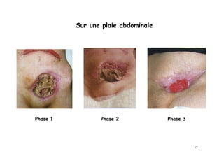 Sur une plaie abdominale




Phase 1          Phase 2             Phase 3




                                               17
 