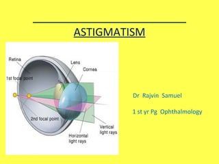   ASTIGMATISM Dr  Rajvin  Samuel 1  1 st yr Pg  Ophthalmology 